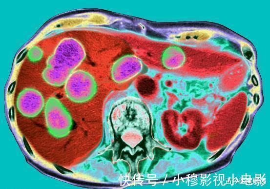 肝癌|36岁女子转氨酶高达391，确诊肝癌，医生告诫：一种家常菜是“祸根”