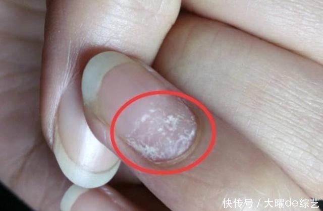 毒素|看“中指”就能看出肝的好坏,若没有这3个现象,那么,肝很健康