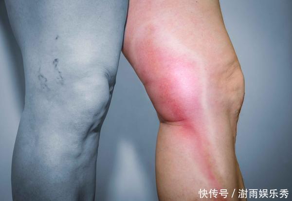 下肢|体内有栓，手脚先知？手脚若有这4种异常，或是血管在“求救”