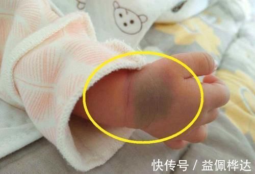 孕期|胎记是怎么来的?产科大夫:天生的除外,孕期这3种行为尽量避开