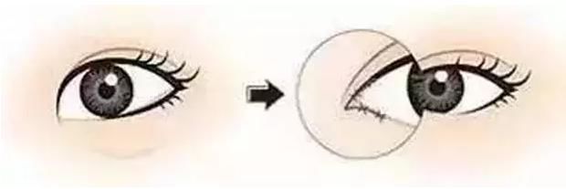 医生|为什么割双眼皮的时候医生总让我开个眼角?