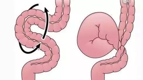 坏死|男孩饭后做了这个动作，一肚子小肠全变黑，15米小肠被切除