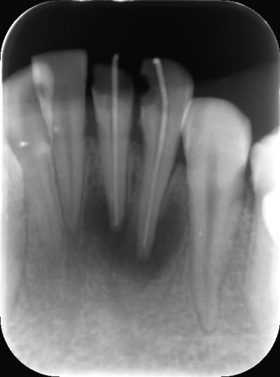 牙片|“看个牙还要拍个X光吃个线？”
