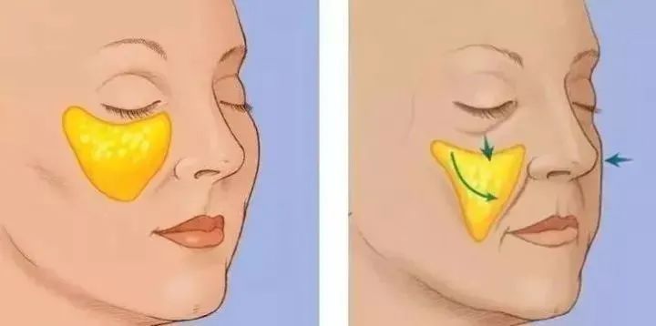 自体脂肪丰面颊|面部填充玻尿酸vs自体脂肪如何选?丨科普篇