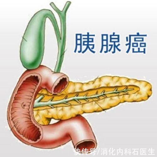 ct|男子腹痛、黄疸，以为结石手术，打开腹腔医生感慨:肿瘤转移了!