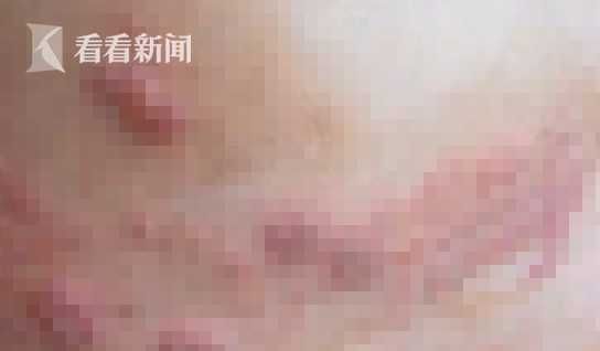 高大叔|男子身上生“蛇”，“秘方”治疗后却被送进ICU