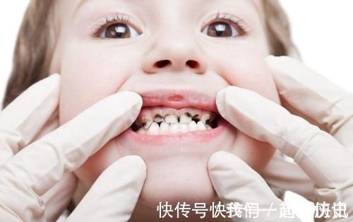 牙齿|不想孩子一口烂牙,这些坑可要避开了,家长多上心