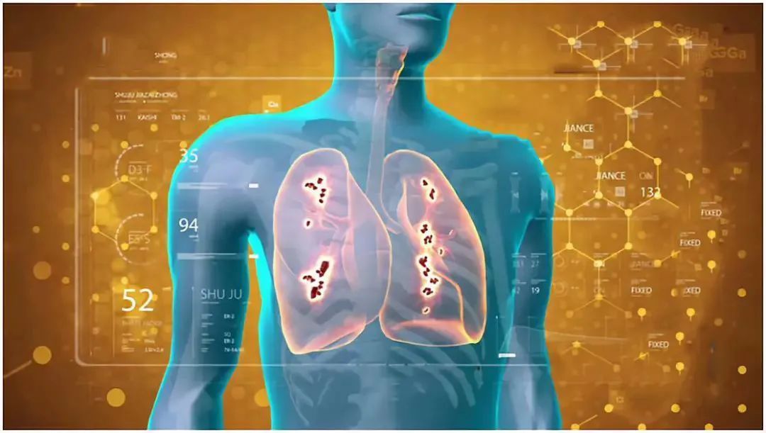 癌细胞|手指长这样,可能是肺癌的早期征兆,1个动作轻松自测!护肺用好这4招~