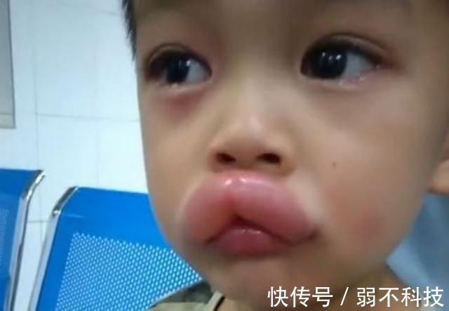 香肠嘴|熊孩子偷吃了一颗葡萄,嘴巴变成了香肠嘴,医生看了都憋笑