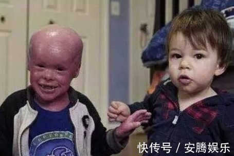 鱼鳞癣|5岁男孩,全身长满“鱼鳞”,父母天天为其刮鳞,大开眼界