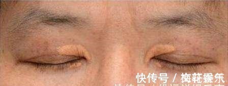 胆固醇|脸上有2个症状,说明血脂很高了,调理高血脂只要2招