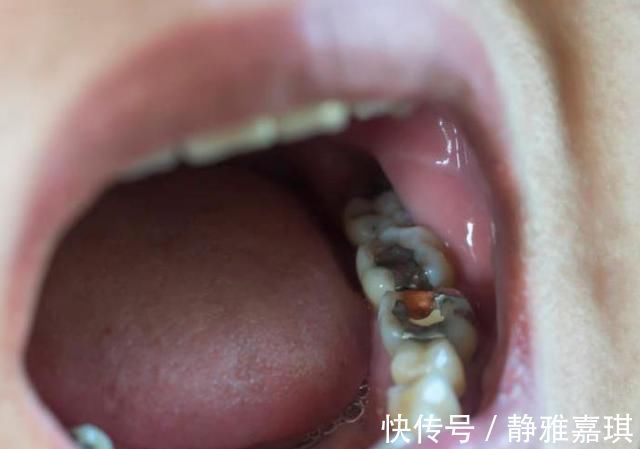 牙齿|10个5岁儿童中,7个有龋齿,罪魁祸首居然不是糖?