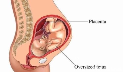 玄机|胎盘前壁是男孩,后壁是女孩?别说,胎盘的位置还真深藏“玄机” 美妈很帅
