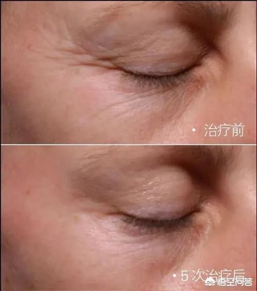 如何防止皮肤衰老、松弛和长皱纹？