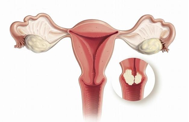 性行为|宫颈癌早期不痛不痒,身体若有3个异常,说明宫颈已癌变,请留心