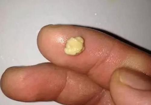 宝妈|儿子因“口臭”被同学嫌弃,带孩子检查,取出来的颗粒果然很臭