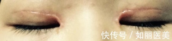 手术 什么样的双眼皮手术意味着失败了?术后多久才能进行二次修复?看完这篇,你就知道啦~