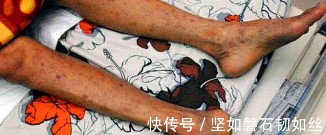 症状|感染艾滋只需0.1秒身体出现这3个症状,别拖到“并发症”发威