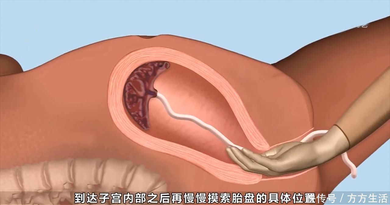 人工流产|5种产妇容易'手剥胎盘',第4种引发几率高,孕妈别忽视