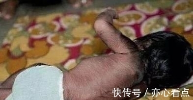 蔡女士|32岁产妇生下”猴子”,小两口崩溃大哭,医生看到宝宝后却笑了
