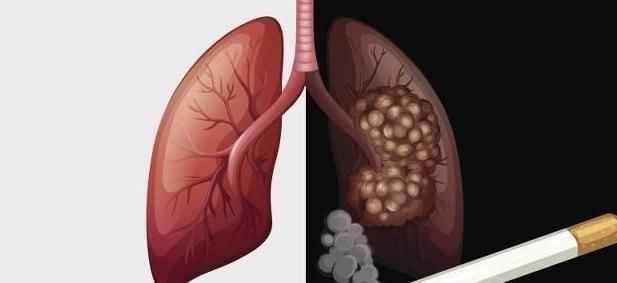  会增加患肺|“肺癌”的原因是什么？除了吸烟，可能还是“3件事”导致的！