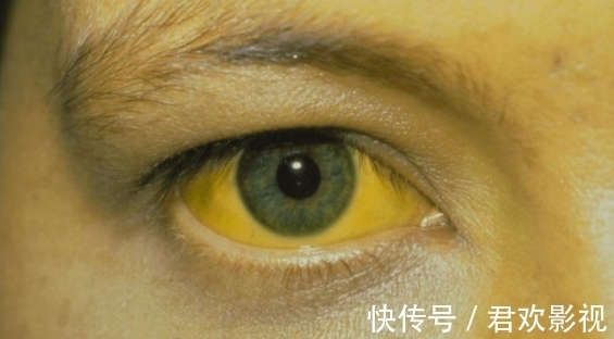 老黄|每吃一口等于在肝脏打洞，肝科主任：2种“素食”比酒伤肝，尽量少吃