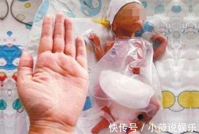 孕妇|世界上最小的婴儿宝宝，身长同一支钢笔，如今过得怎么样？