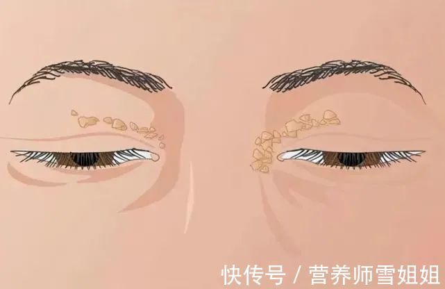 超标|一旦出现4种迹象,说明血脂“超标”了,需给血管“洗洗澡”了