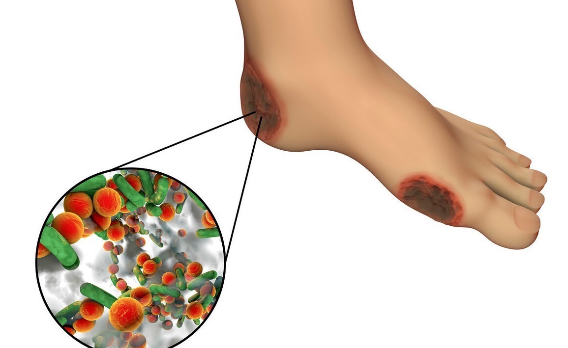 症状|糖尿病足是每个糖友的“噩梦”!医生提醒出现4个症状就该警惕