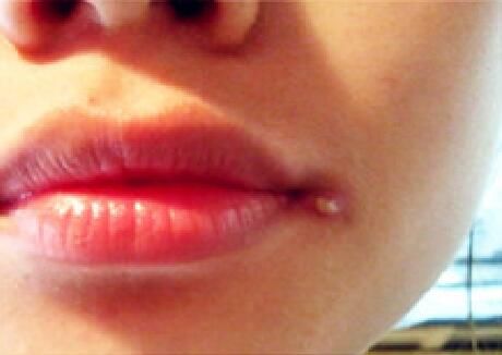 湖南省第二人民医院|男子挤压嘴角的一个小脓包，竟差点丢性命