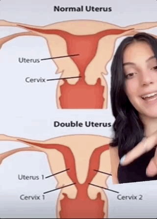 子宫|18岁少女有两个子宫?一月流两次血