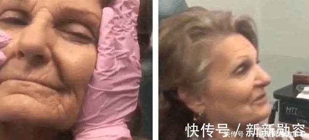 美美|80岁奶奶打玻尿酸,仿佛年轻了40岁:老了也要美美的