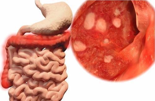 乳腺癌|父母有以下3类癌症,子女就要警惕起来了!最好定期检查