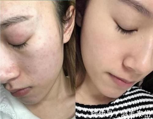 敏感肌|刚打湿脸就急着抹洗面奶，难怪黑头闭口疯长，教你正确的洗脸方式