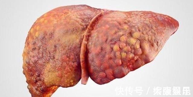 列入|世卫组织:3种蔬菜已被列入伤肝“黑名单”,转告家人,尽量别吃