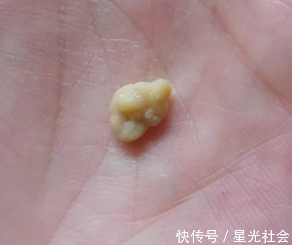 检查|孩子因嘴臭遭同学嫌弃,检查后取出这东西,亲妈都嫌臭