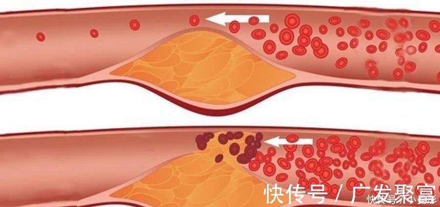 血管堵塞|这些食物堪称高血脂“克星”, 常吃血脂不高, 血管越来越通畅!