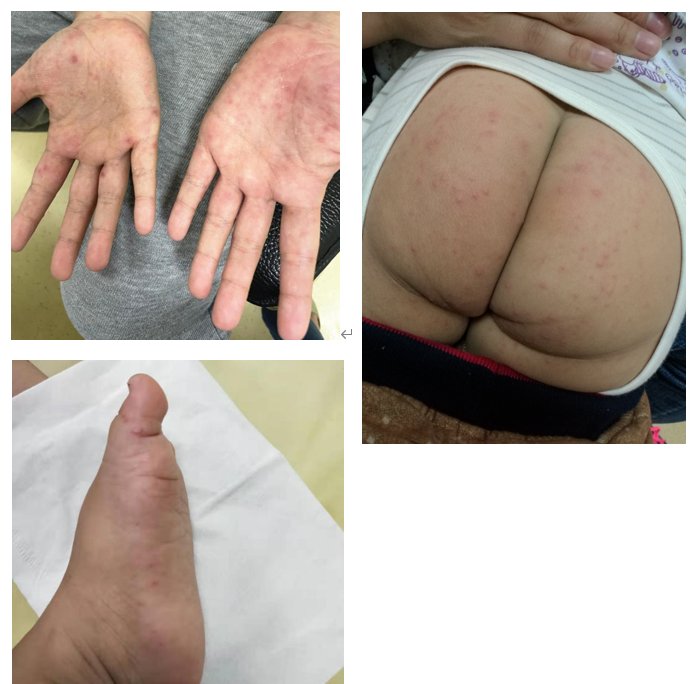 南京市儿童医院|疱疹性咽峡炎来袭 专家提醒：这几点家长一定要知道