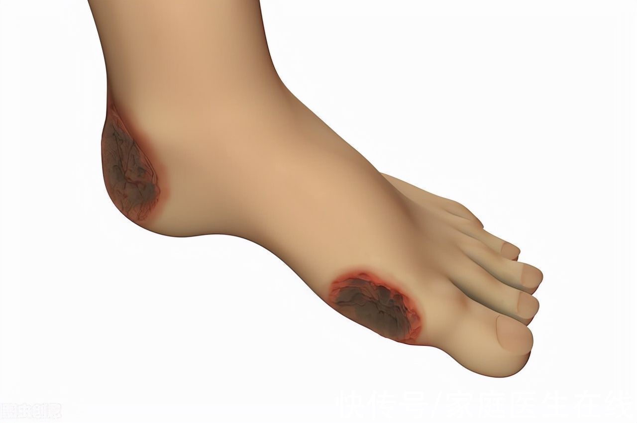 糖尿病足|得了糖尿病，就仅仅是血糖高？提醒：这4种并发症，别放任不管