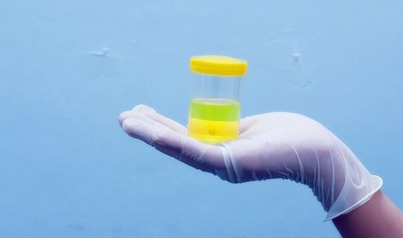 血糖|糖尿病患者的尿又黄又骚是什么原因?你真的知道吗?看专家的理解