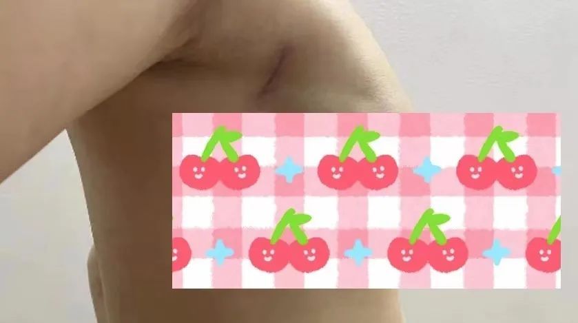 黄建|29岁患乳腺癌，这种手术方式居然找不到疤痕？健康美丽一步到位！