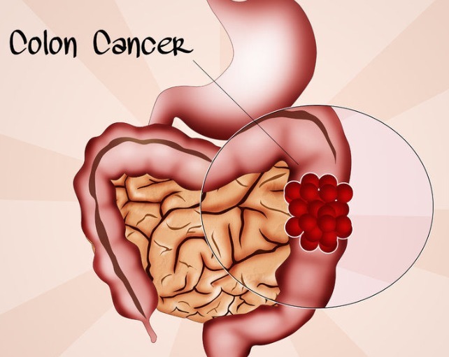 治愈|三种癌症比较难以治愈,存活期短,大家要引起注意