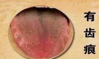 舌头|脾虚百病生,不论男女,如果有3种症状出现,最好抓紧时间补脾