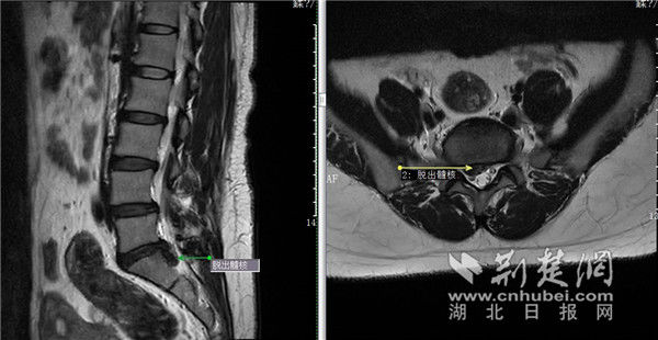 腰椎间盘|女设计师久坐又抱娃腰疼腿麻到无法动弹
