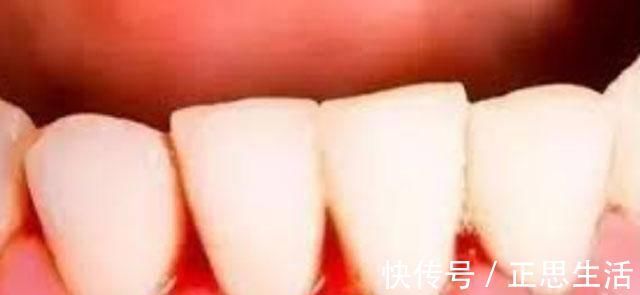 肝癌|肝癌一检查,不是中期就晚期,肝病专家注意身体上的几个症状