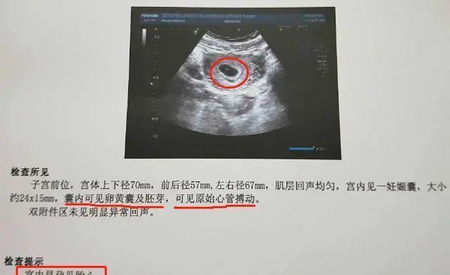 孕囊|孕期反应看男女?过来人说出“大实话”,告诉你什么才是最准确的