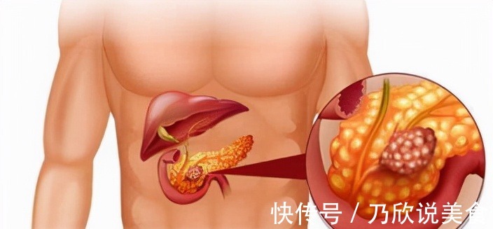 胰腺|50岁肿瘤专家患癌,抗癌一年去世,临终前留下一个反思,引人深思