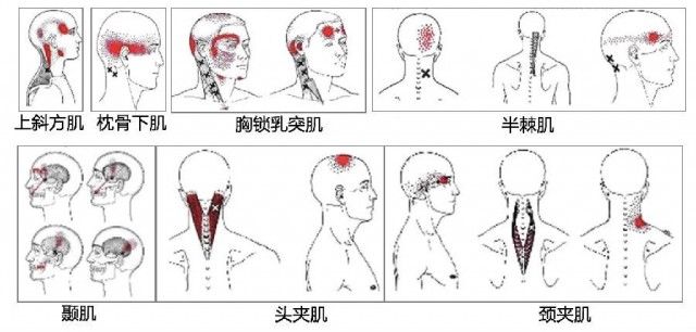 颈椎|八成头痛和颈椎有关！一份“疼痛位置图解”帮你对症放松