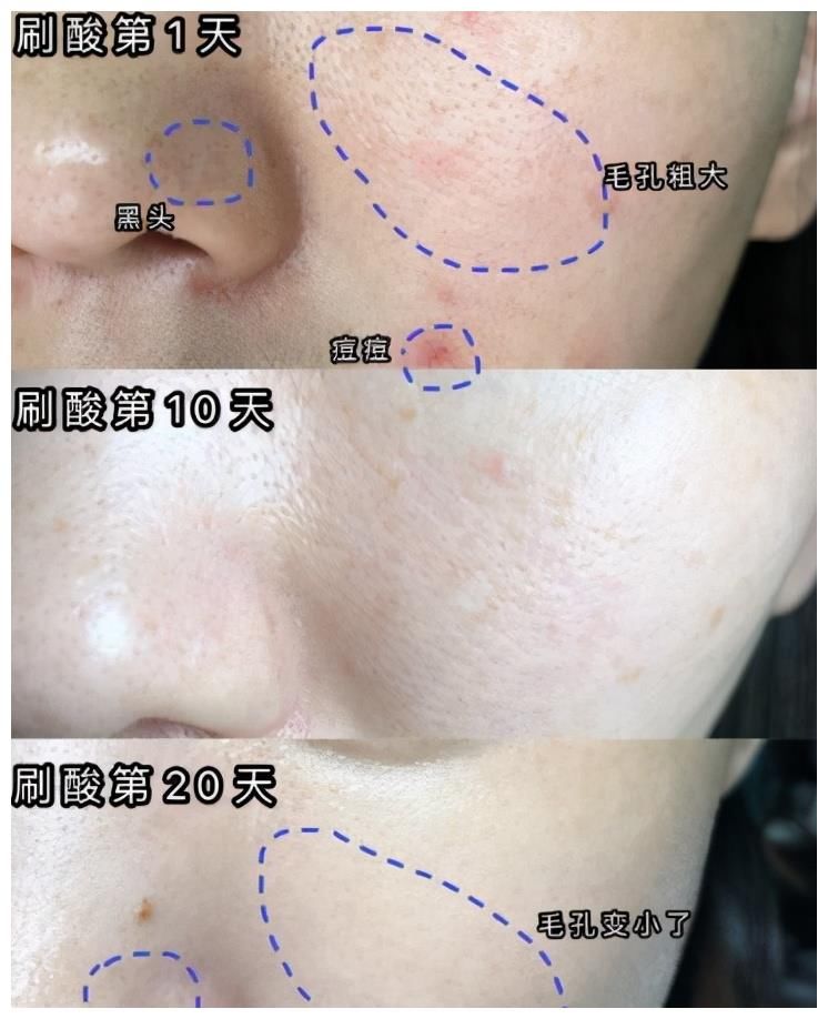 你真的懂刷酸吗？刷酸都有哪些好处？