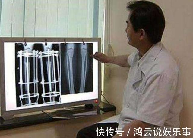 增高|还记得那个花16万、断骨增高7.2厘米的李亚诺吗?后来身体怎样?